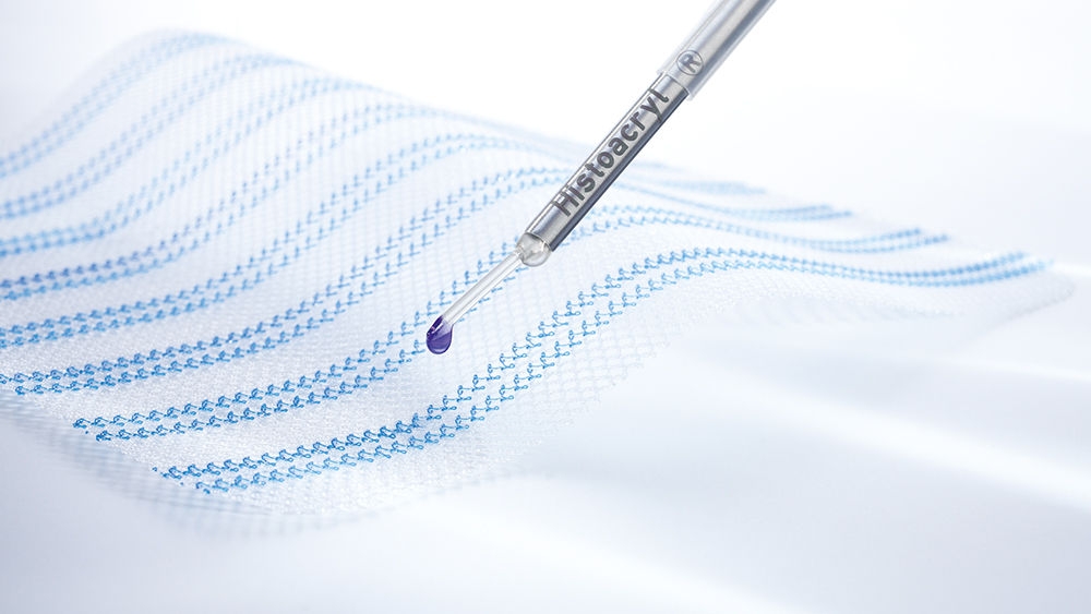 Lưới phẫu thuật với dụng cụ đặt Histoacryl® LapFix để cố định lưới